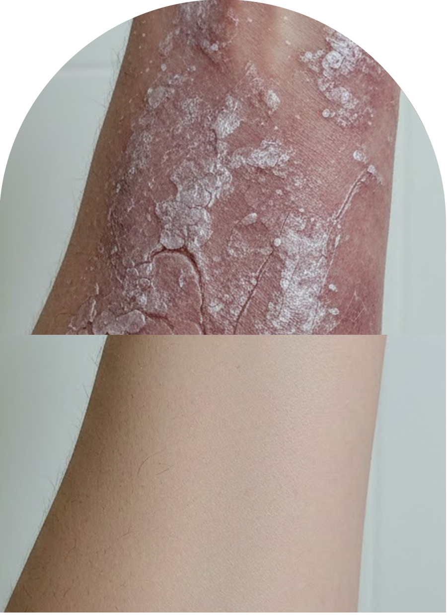 Difficult to treat skin disorder