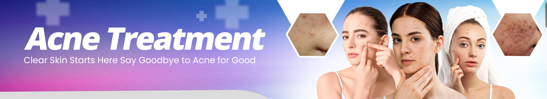 Acne Treatment