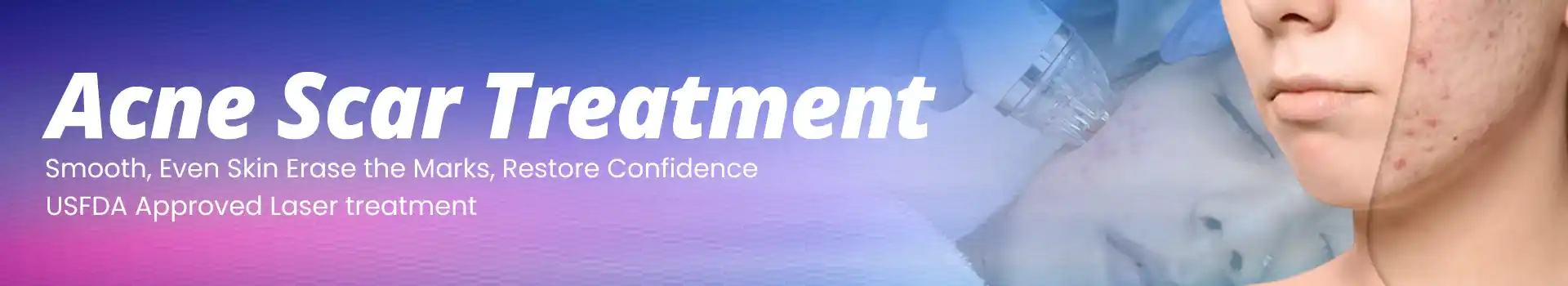 Acne Scar Treatment