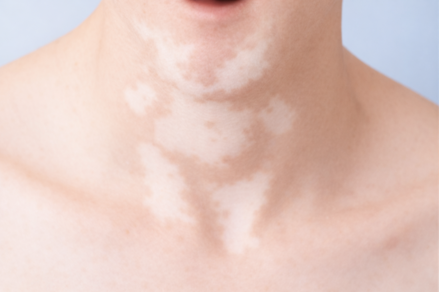 Vitiligo Treatment